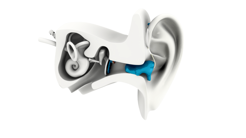 Earlens 3D Render edited Earlens